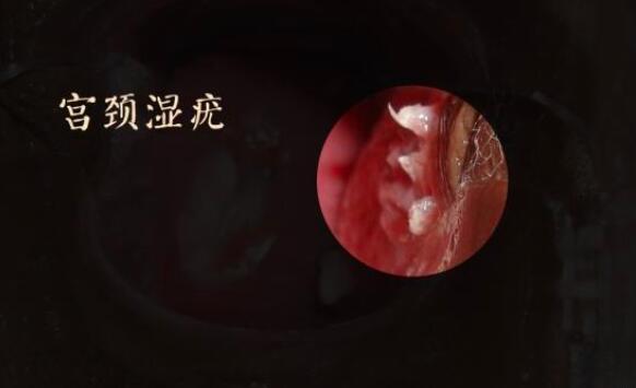 宫颈尖锐湿疣图片