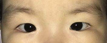 患儿内眦赘皮,遮住鼻侧球结膜,外观呈内斜视,但角膜映光点正位,交替