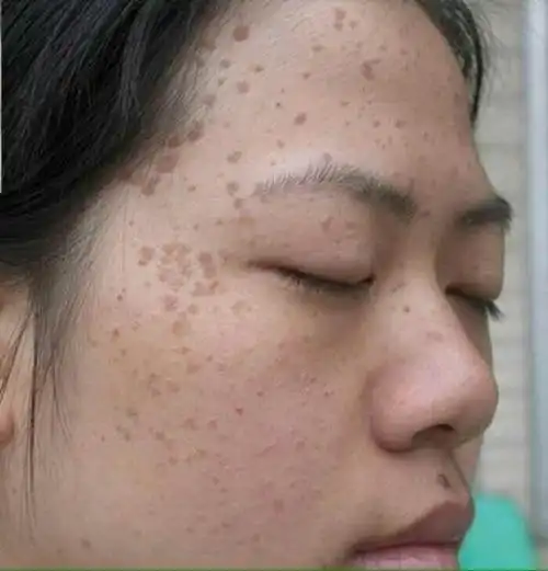 关于扁平疣的几个问题需要了解进来看看咯