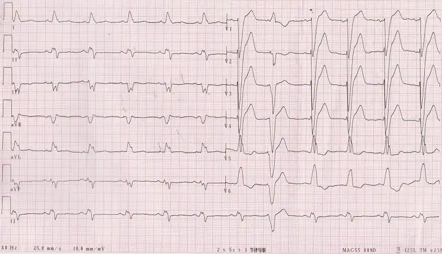 患者入院心电图,提示为窦性心律,完全性左束支传导阻滞,qrs波明显