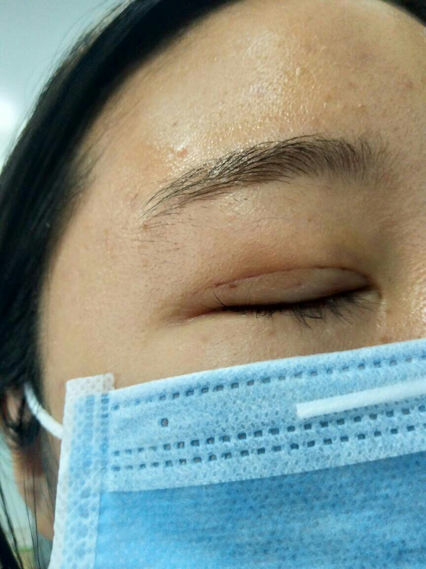 埋线双眼皮第四天 发现眼尾有个很小的小凸起 请专业医生看下是不是