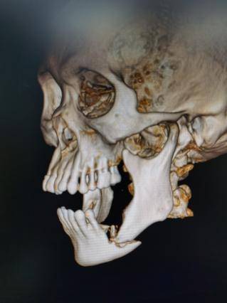 陆军特色医学中心应用创新技术治疗颌骨骨髓炎