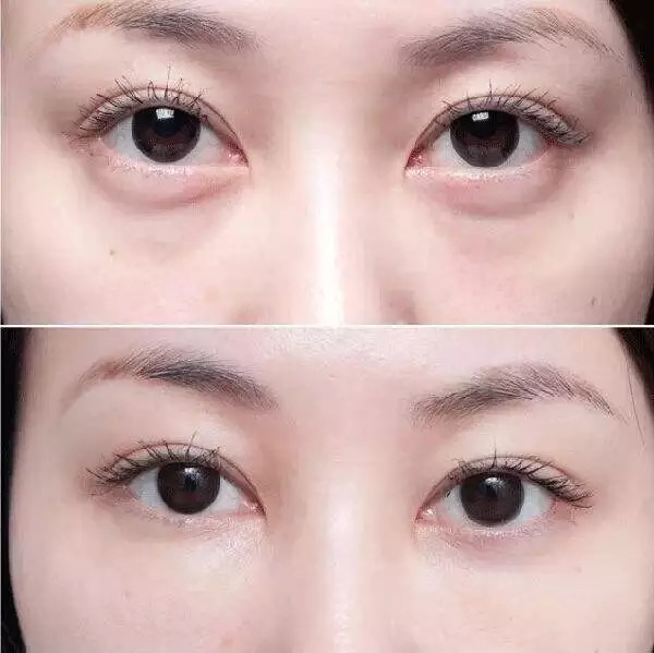 什么是泪沟这可是比眼袋更难对付的顽疾