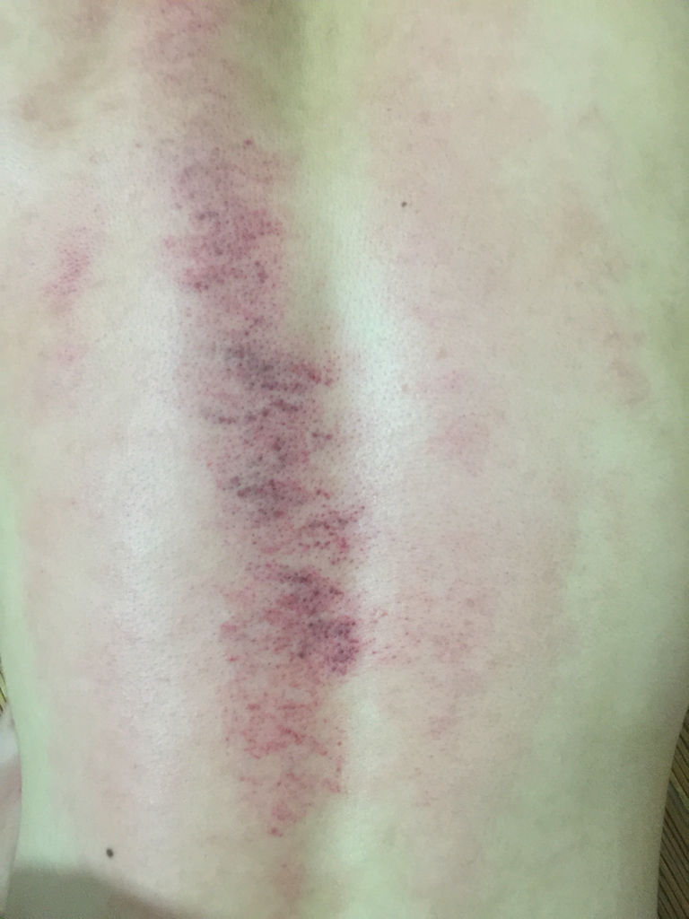 这是自己在家刮痧刮的,这样的是刮出痧了吗?