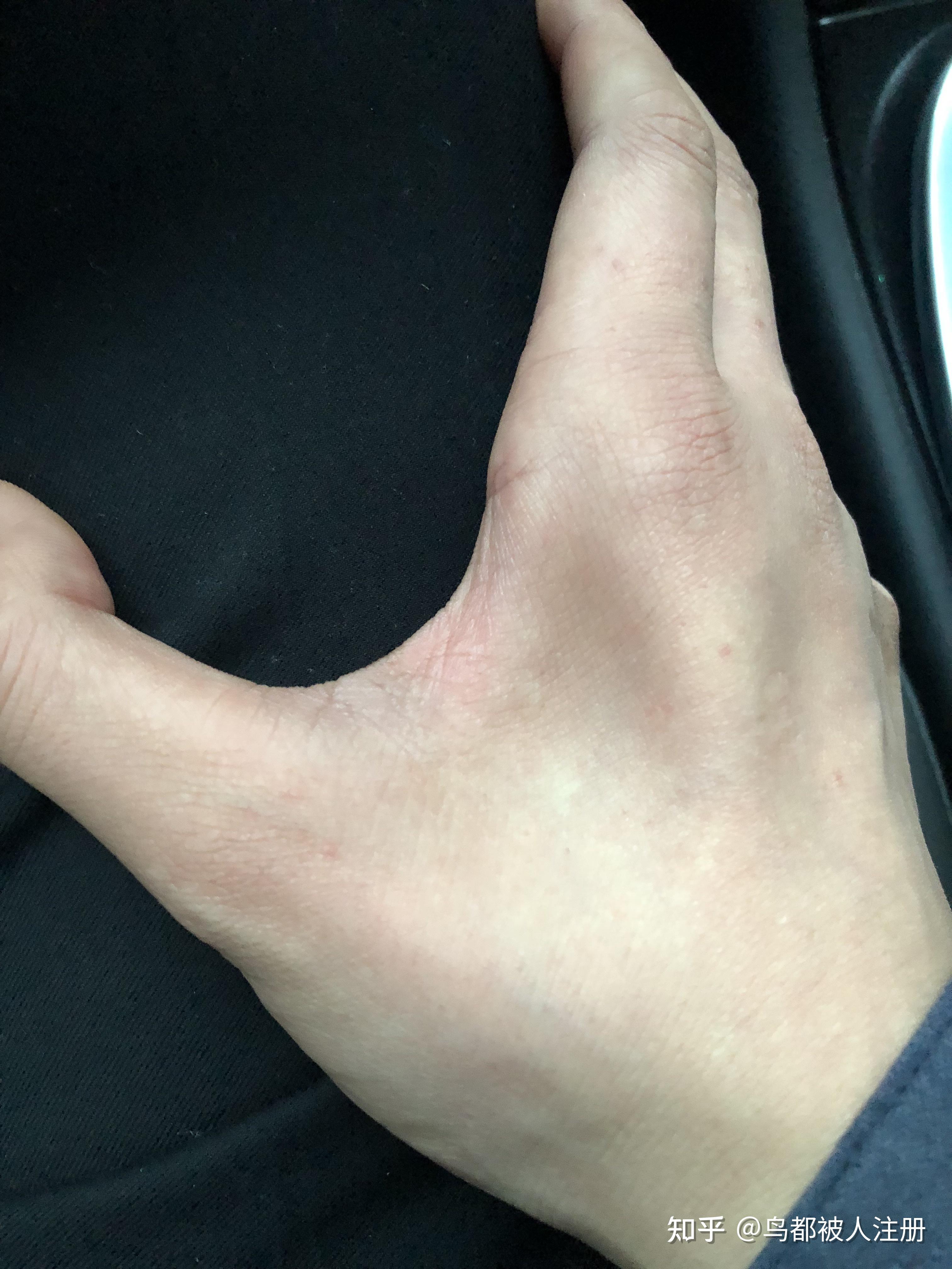 肌肉萎缩77尺神经损伤77松解手术 - 知乎