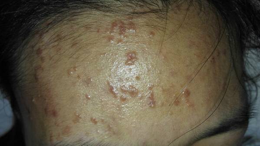 额头上丝状疣症状的图片