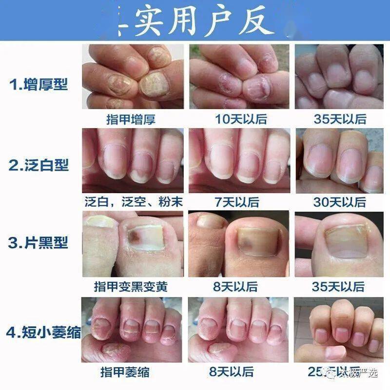一人得灰指甲全家遭殃灰指甲总是反复再生看看这里