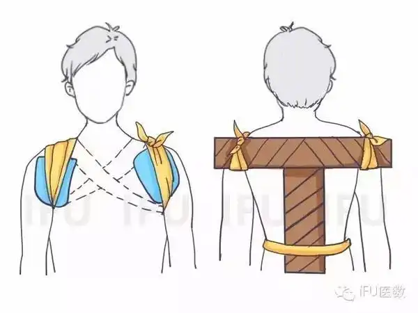 2.三角巾无夹板固定法