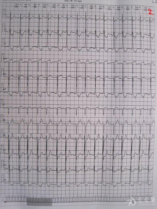 两个房早后的交界性心动过速   交界性的心动过速,不是特别齐