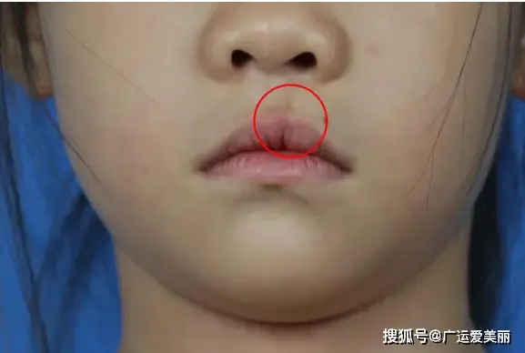 1,单纯唇裂的宝宝宜在3-6个月时手术;2,双侧唇裂的宝宝宜在6-12月时