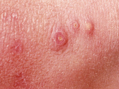 怎么感染上生殖器疱疹的呢 生殖器疱疹的症状特点有哪些?