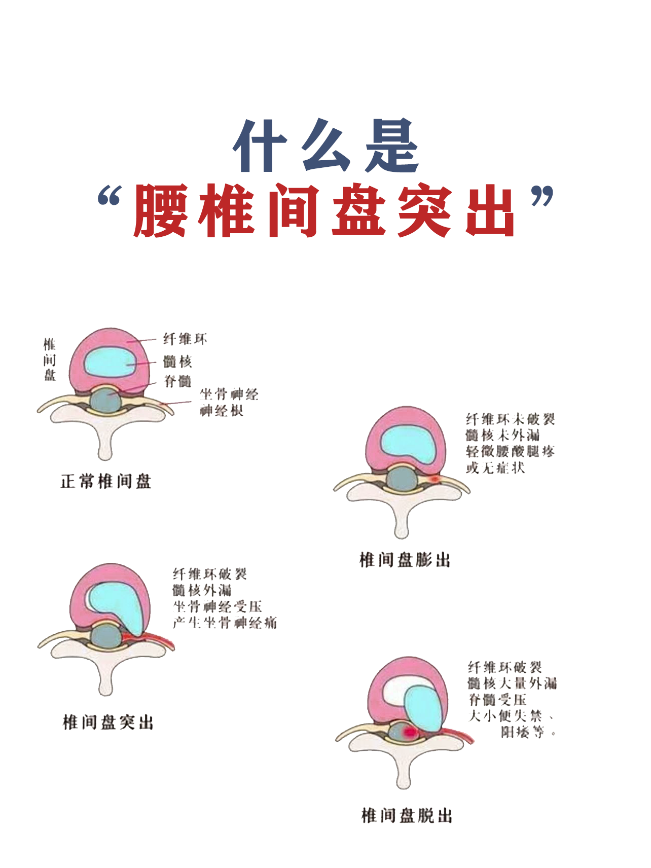 腰椎间盘突出的知识科普