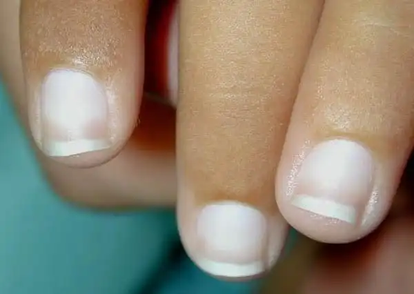 指甲突然"出现一条条横纹"恐是心脏出问题!