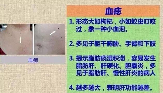 认识我们身体上的三斑,黑斑,白斑,血痣!_血管