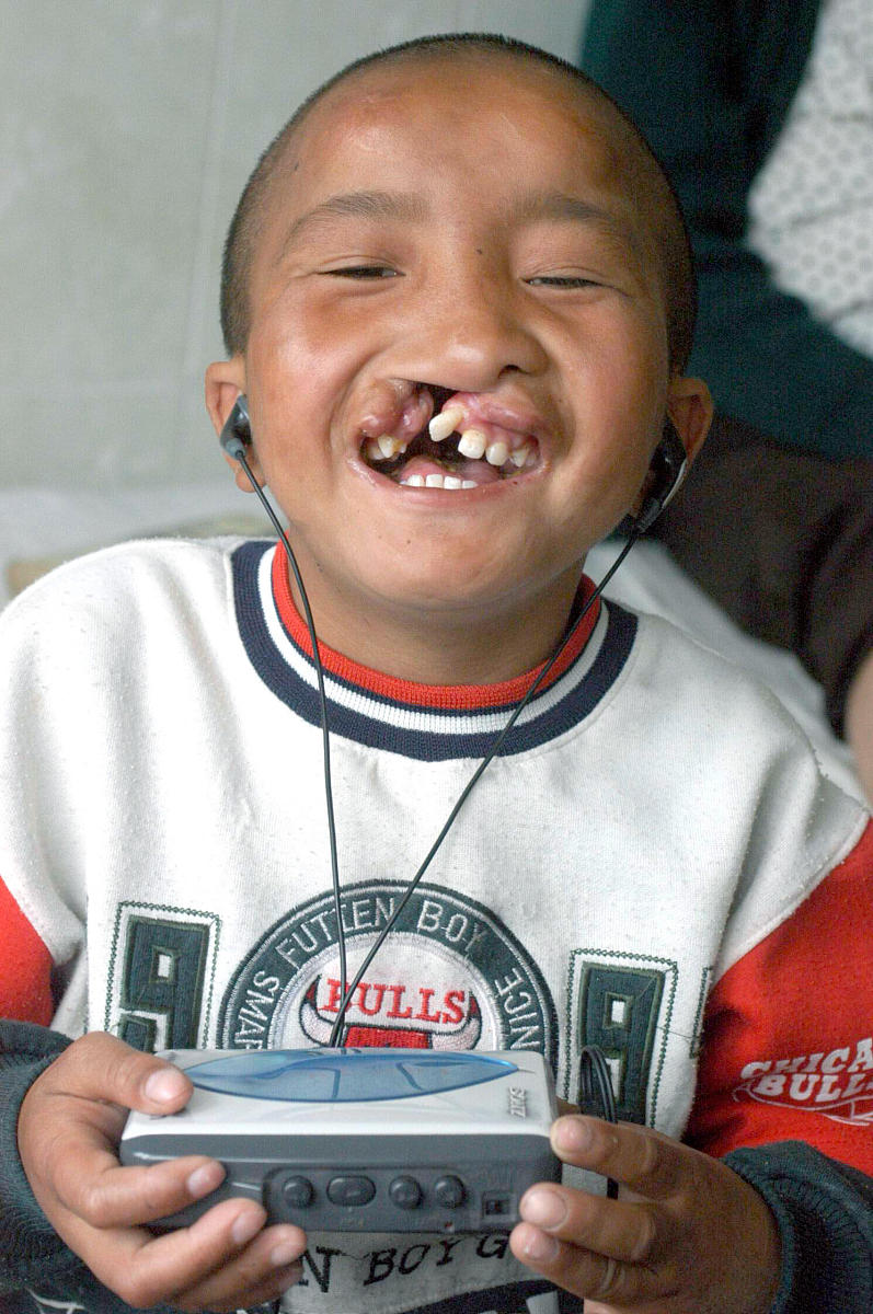 兔唇会遗传给下一代吗 #唇裂畸形手术#   兔唇是一种先天性口腔颜面部