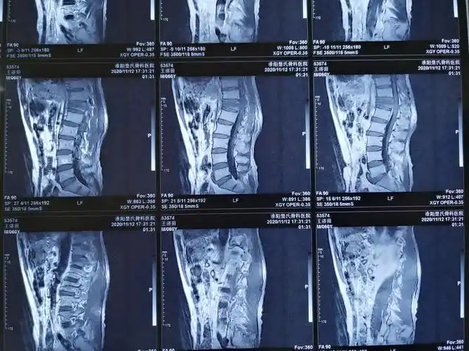 王济田胸12椎体chance骨折