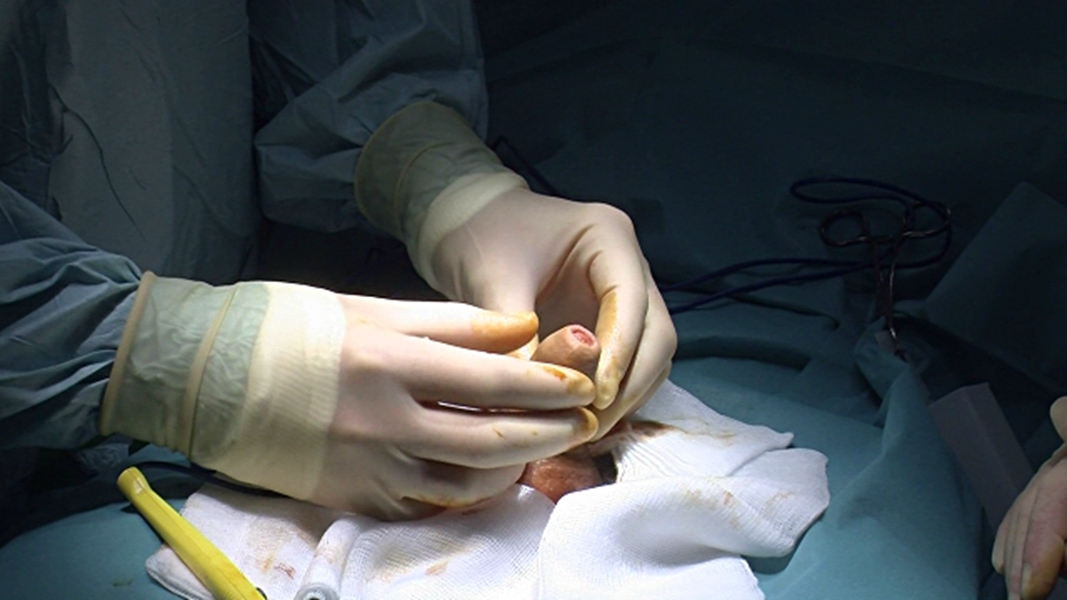 香港包皮过长医院_香港治疗包皮过长哪家医院好_香港