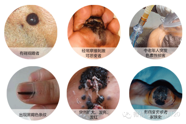 微信号:hkxgltj120 或者微信搜索 陈建平新浪微博:@血管瘤医生陈建平