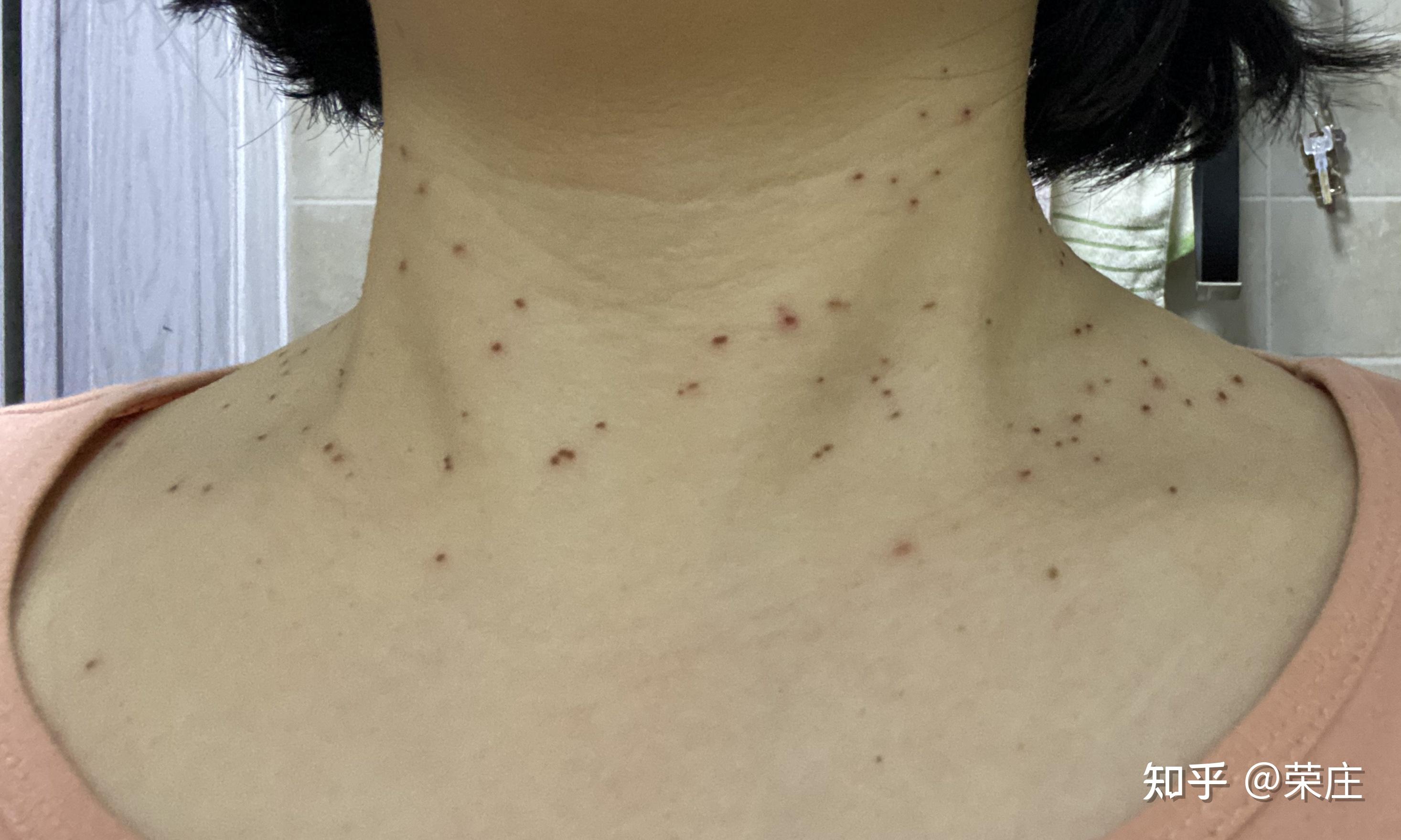 丝状疣治疗记录