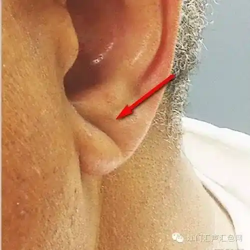 耳朵上发现这个东西,你可能患了心脏病!