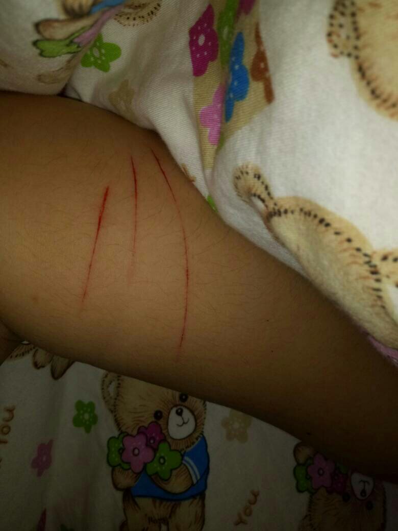 用美工刀在手臂上划了三道,需不需要打破伤风?