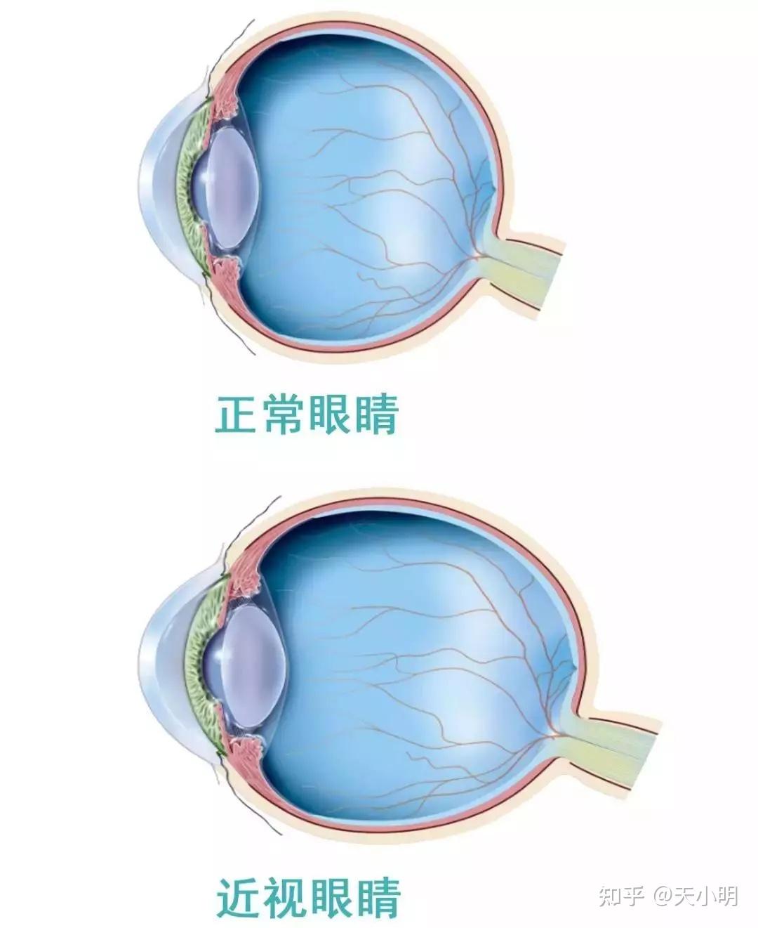低度近视眼(小于300度)并发症很少,而高度近视者(大于600度)其眼球
