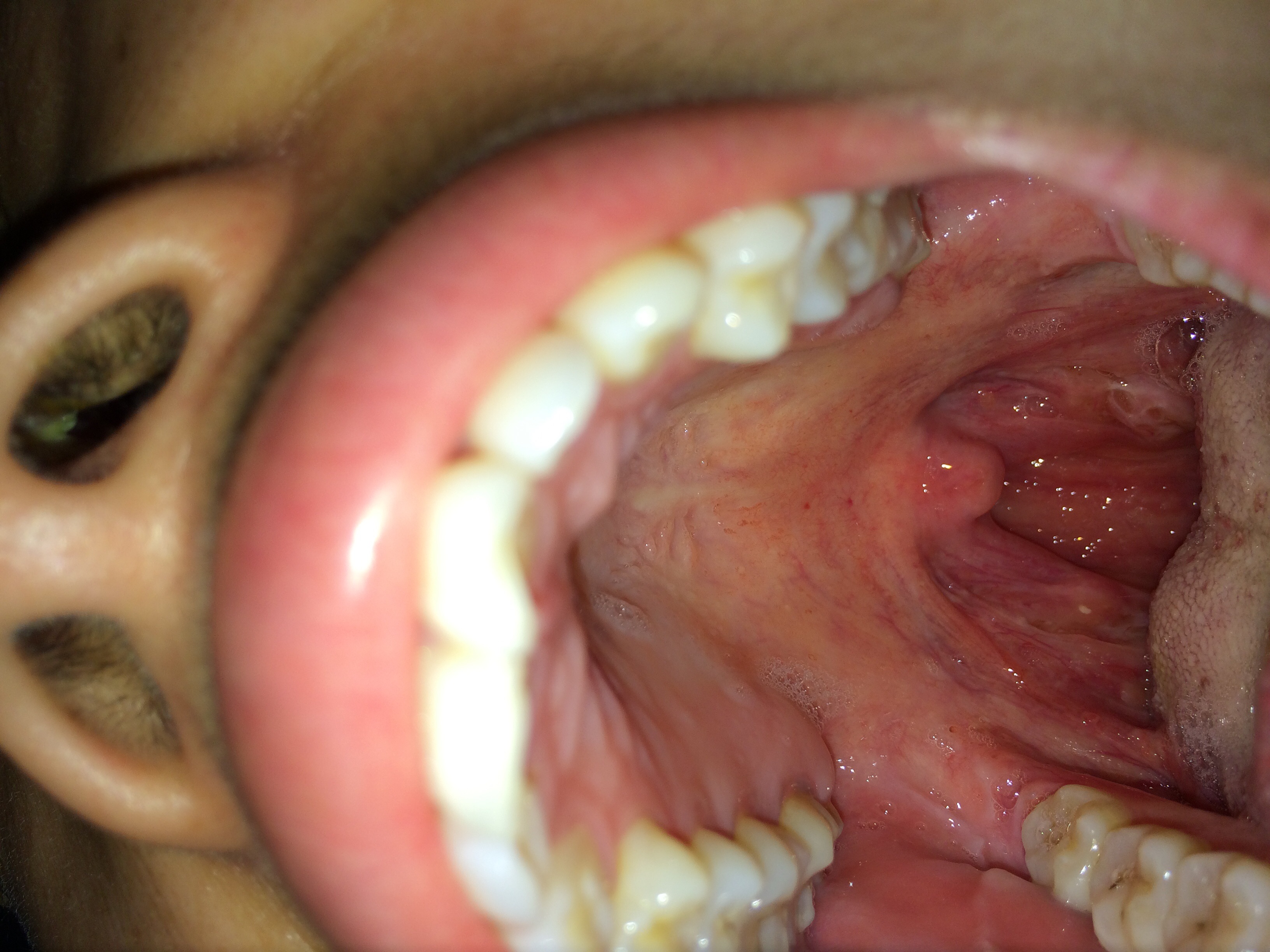 扁桃体上面有类似水泡的东西还发炎了打了青霉素好些了后来有