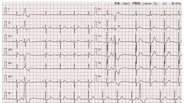 4 种判定心电轴偏移方法,你知道几种?| 心电视频第 6 期