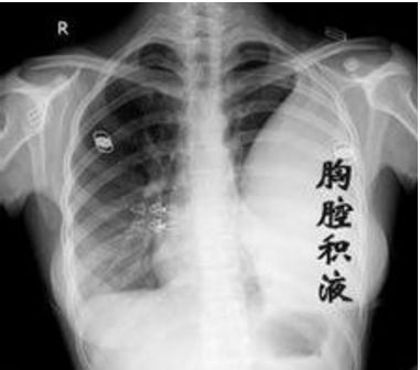 肝硬化病人出现胸腔积液是怎么回事?  肝硬化病人伴有胸腔积液胸水的