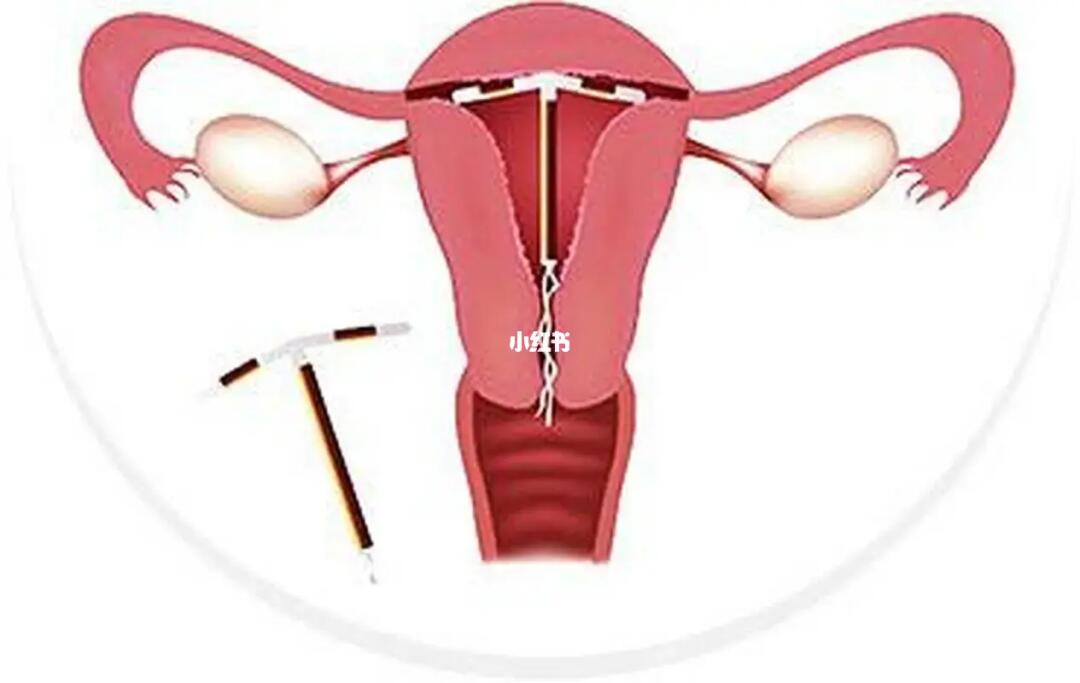 曼月乐环  可以在 #子宫  内局部释放 #孕激素  , #孕激素 可以抑制