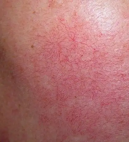 护肤之 面部红血丝篇