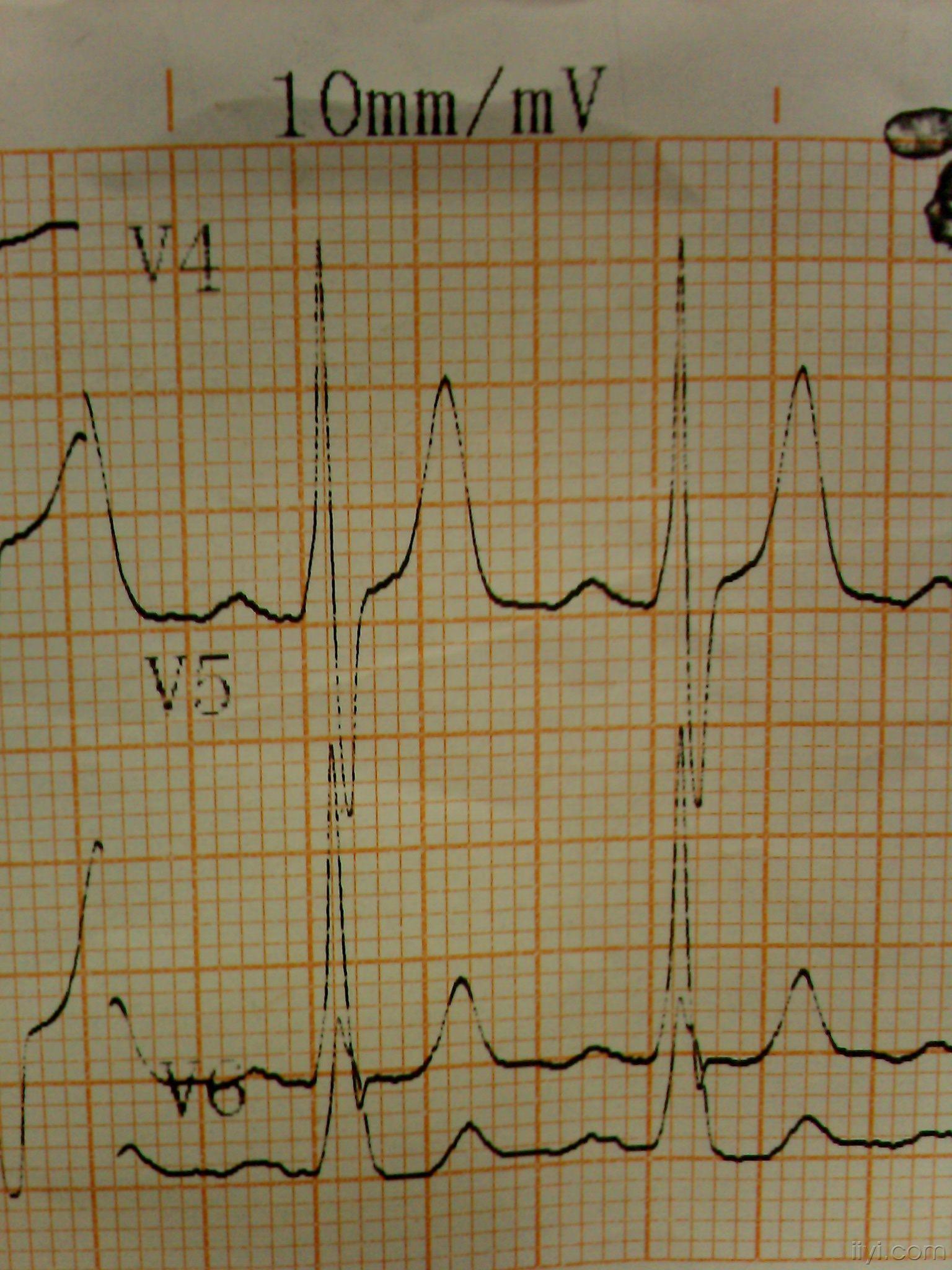 急急急急急急请教各位下列心电图诊断是什么该如何处理