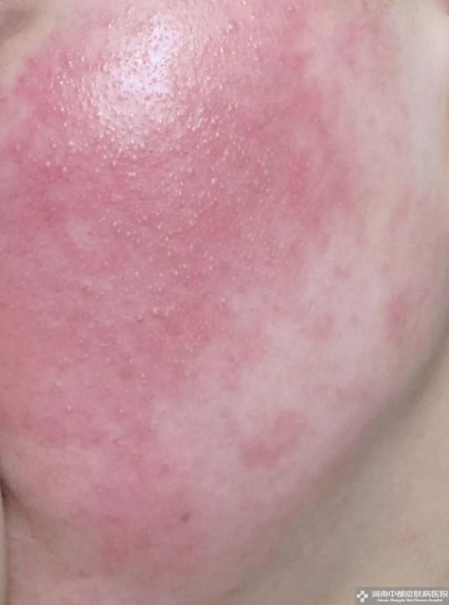 皮肤过敏,又红又痒,怎么办?