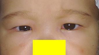 婴儿性(先天性)内斜视_小儿斜视_小儿斜视疾病介绍 - 好大夫在线