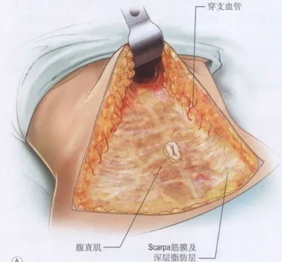 腹部拉皮术过程