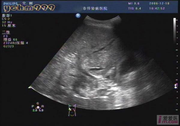 酒精性肝硬化伴肝ca,门脉血栓