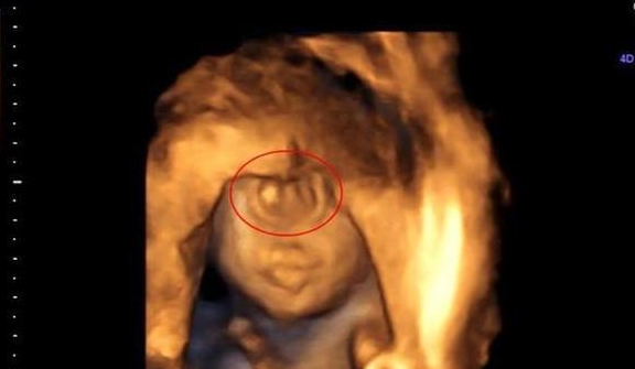 "都怪我"宝妈怀孕看b超以为是双胞胎,孩子出生宝妈后悔_医生_女士