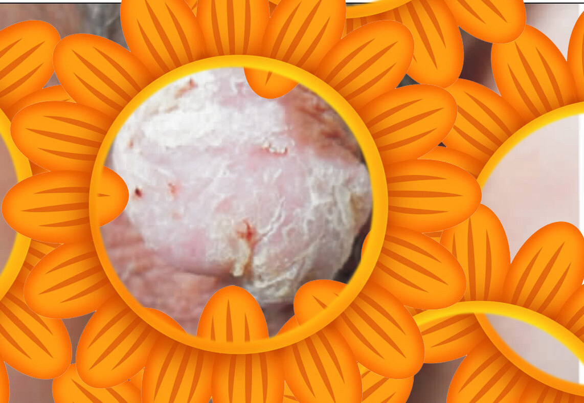 丁丁上的雀斑--云母状角化性假上皮瘤性龟头炎_包皮龟头炎_介绍_检查