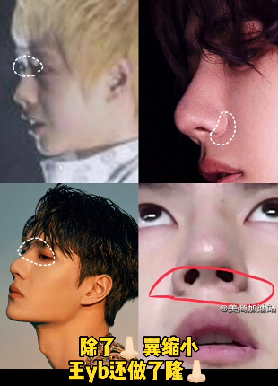 王一博鼻子疤痕又暴露了之前广告就被质疑不知是卡粉还是伤疤