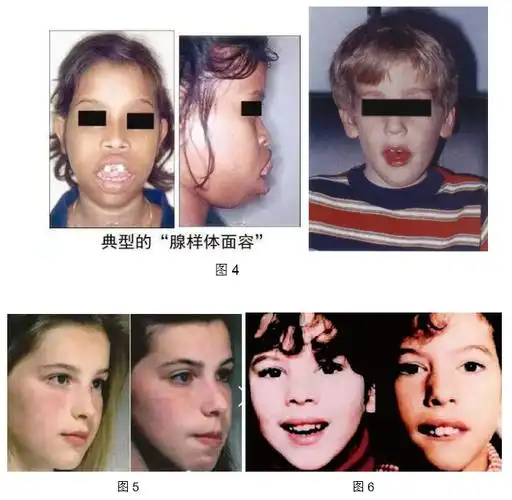 5,其它病因如肥胖,鼻息肉及鼻中隔偏曲,先天性后鼻孔闭锁,舌体肥大