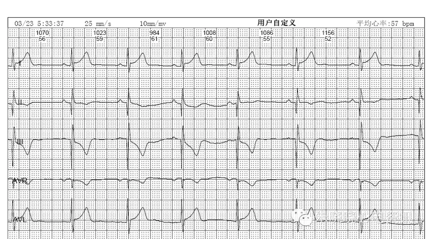 一个病人两份不同的心电图报告 - 好大夫在线
