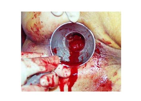 痔疮长啥样子图片外痔疮是什么样子图片2022已更新今日更新