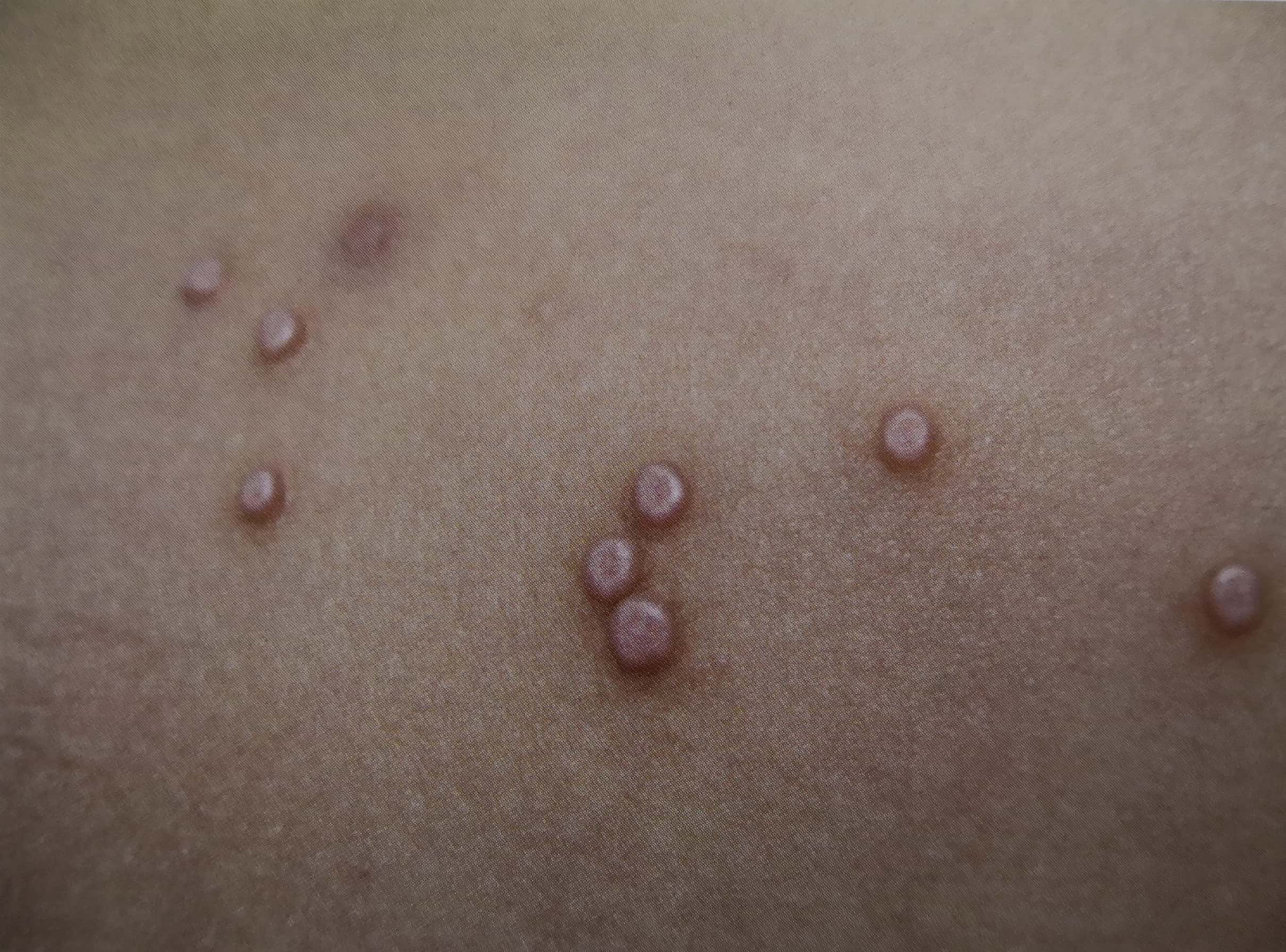 传染性软疣症状_病因_治疗方法_鉴别_专家咨询|丁香医生