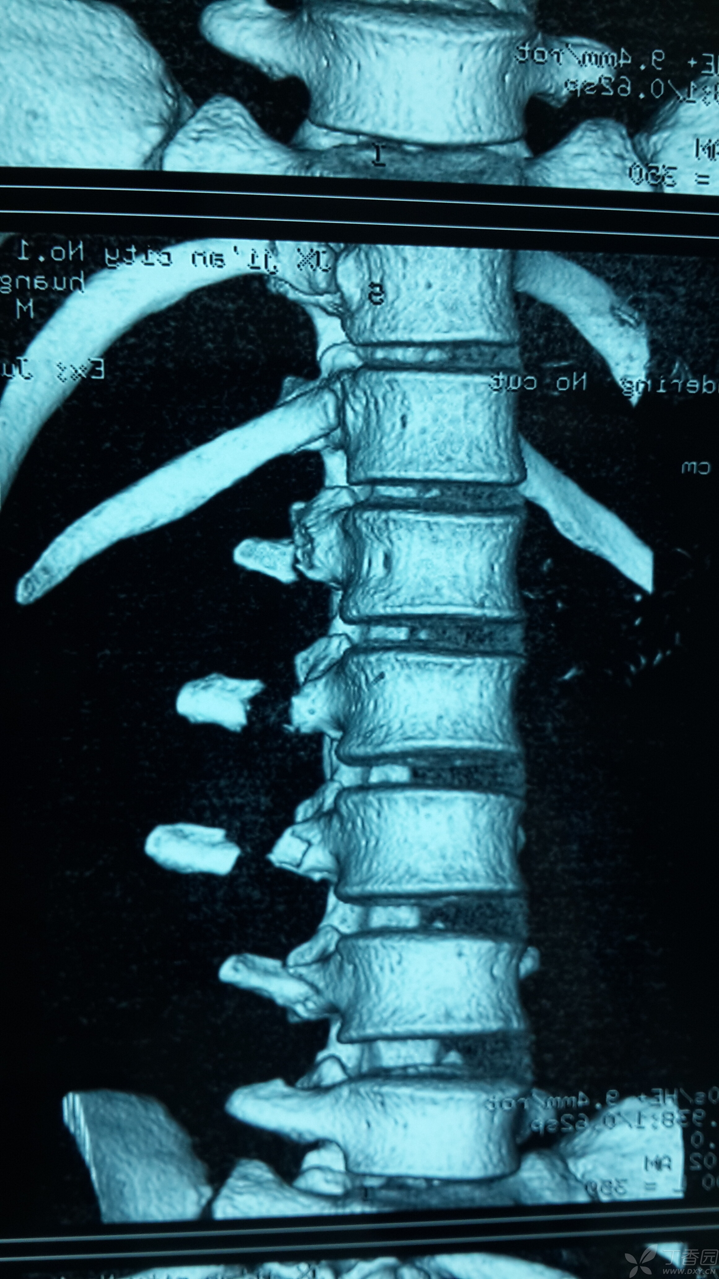 多发腰椎横突骨折一例,需要手术吗