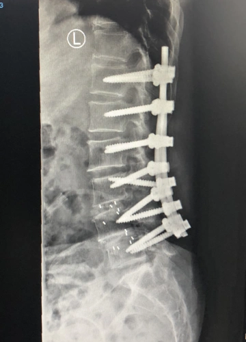 植入12枚钉子才能挺腰姚女士的病这类人也可能患