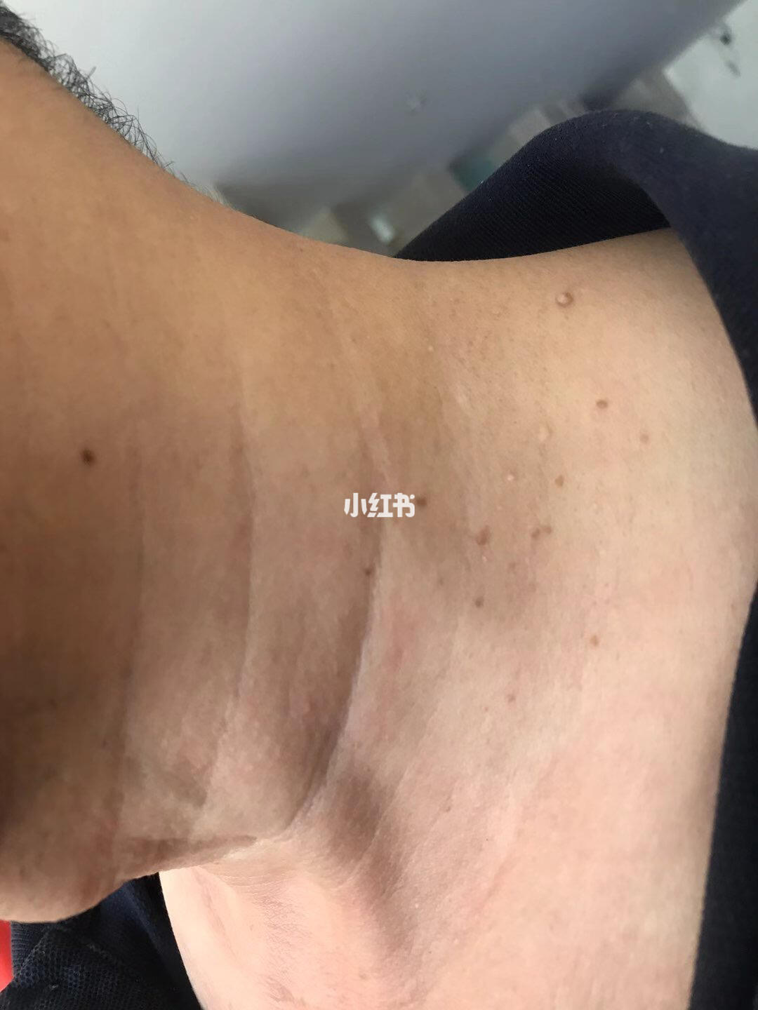 男同志都不能容忍自己的脖子有丝状疣你呢