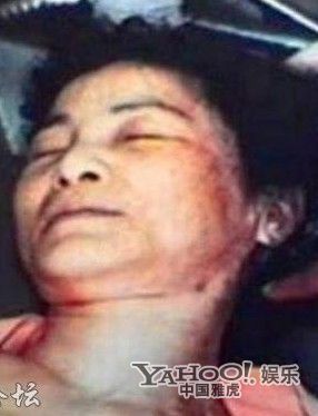 邓丽君绝密尸检照首度曝光 疑生前曾遭人掌掴(组图)