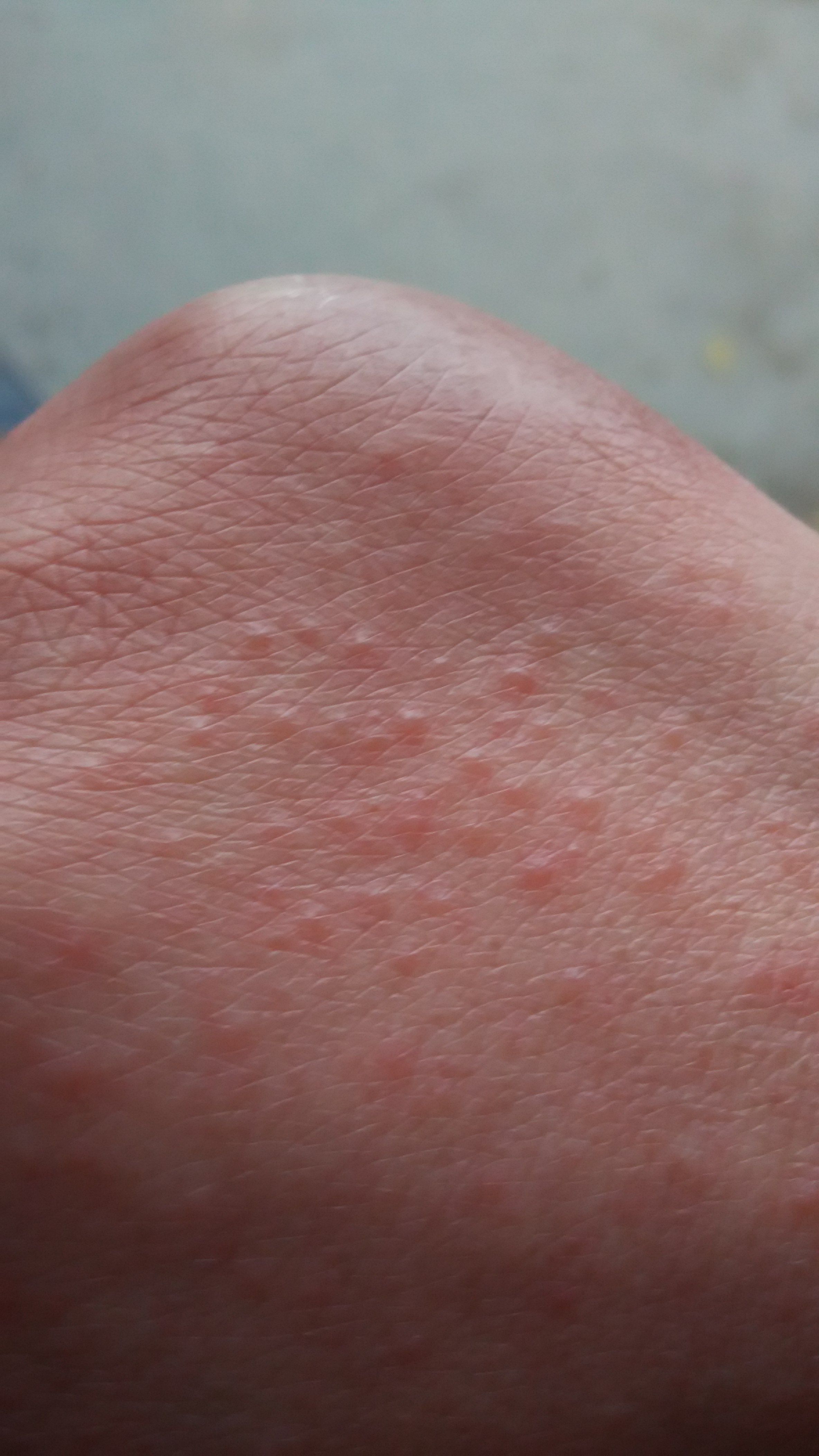 手面起了好多小疙瘩,密密麻麻的,是怎么回事?