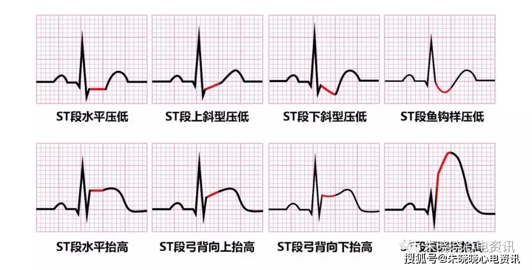 st段抬高不一定是心梗,这8张心电图必须鉴别!
