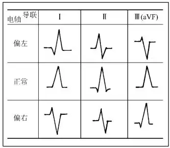 心电轴的测量方法及意义_挂云帆